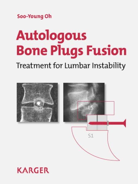 Autologous Bone Plugs Fusion: Treatment for Lumbar Instability: 3E Criteria/ Technical Operative Notes/ The Functioning of the Oh's Screw