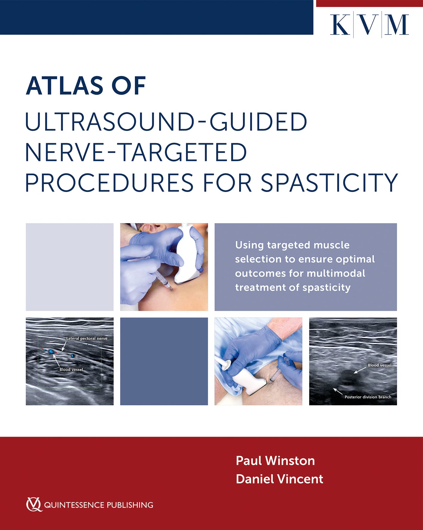 Atlas of Ultrasound-Guided Nerve-Targeted Procedures for Spasticity: Maximizing Outcomes for the Patient with Spasticity Through Optima Muscle Selection